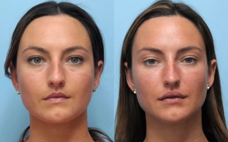 Smooth and Tighten with the Best Plastic Surgeon in Dubai for Thread Lift