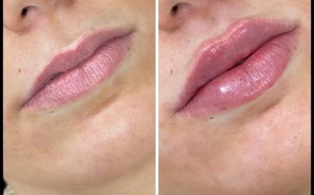 Russian Lip Fillers: How the Best Doctors in Dubai Tailor Treatments for Individual Needs