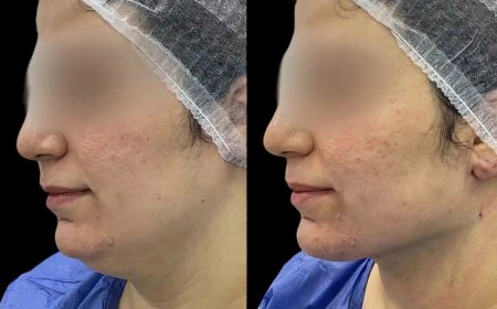 The Role of the Best Doctors in dubai in Chin fillers Aesthetic Treatments