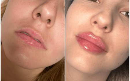 Can Dermal Fillers Be Combined with Other Aesthetic Treatments at the Best Aesthetic Clinic in Dubai?