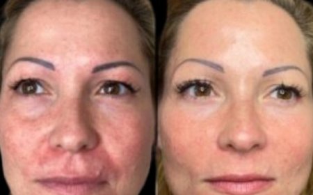 Reignite Radiance with Profhilo by Best Aesthetic Clinic in dubai