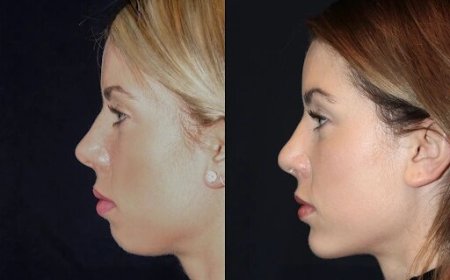 Best Aesthetic Clinic in dubai for Chin Fillers: Enhancing Your Natural Beauty