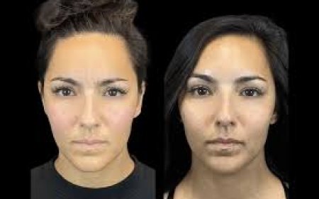 Botox vs. Fillers: Which Is Right for You Visit the Best Aesthetic Clinic in Dubai for Expert Advice