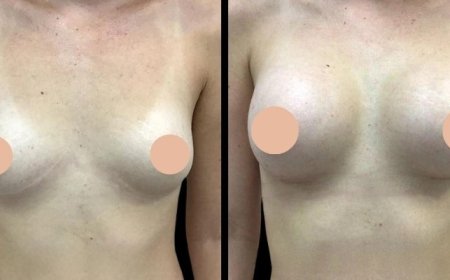 What to Expect from Breast Augmentation in Dubai: A Complete Guide