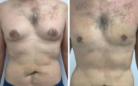 How Long Does It Take to See Results from Gynecomastia Surgery in Dubai?