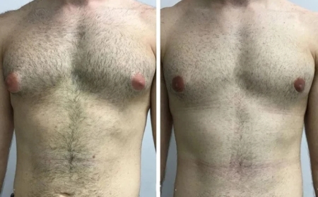 The Journey to Confidence: Success Stories with the Best Gynecomastia Surgeon in Dubai