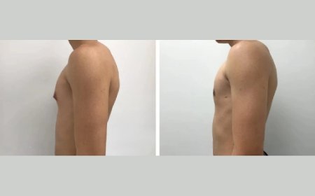 Choosing the Best Gynecomastia Surgeon in Dubai for Your Specific Needs