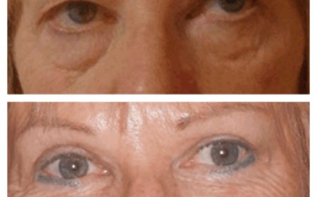 Why You Should Trust the Best Eye Bag Removal Surgeon in Dubai with Your Face