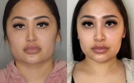 Buccal Fat Removal Cost Breakdown by the Best Buccal Fat Removal Surgeon in Dubai