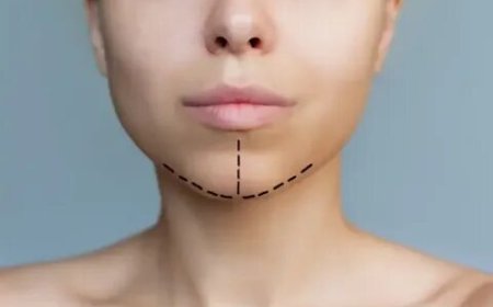 Chin Liposuction Chicago for Sleek, Sculpted Contours