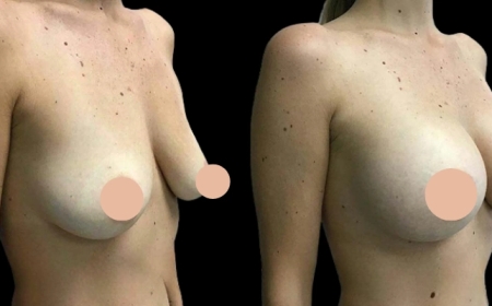 Where to Go for Breast Augmentation in Dubai?