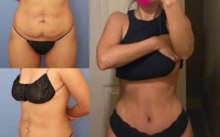 Tummy Tuck in Dubai: A Comprehensive Guide to the Procedure