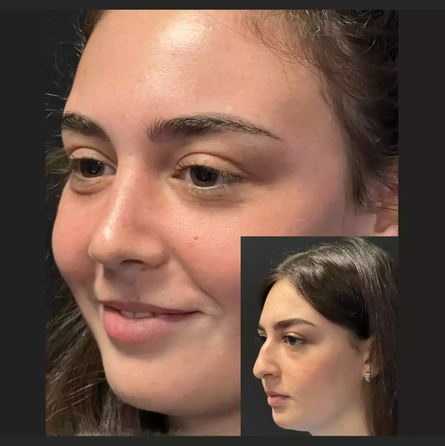 Combine Nose Surgery with Other Facial Procedures in Dubai