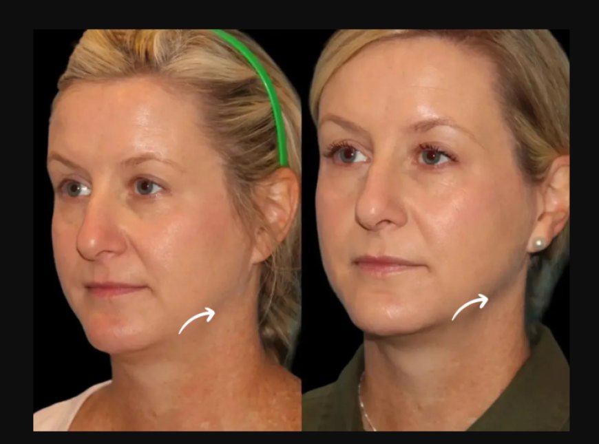Best Doctors in Dubai Optimize Sculptra Fillers with Supplements