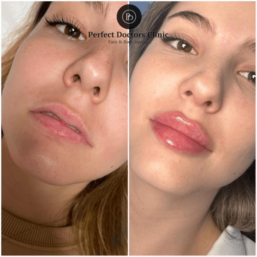 Juvederm for Natural Beauty Enhancement with the Best Doctors in Dubai