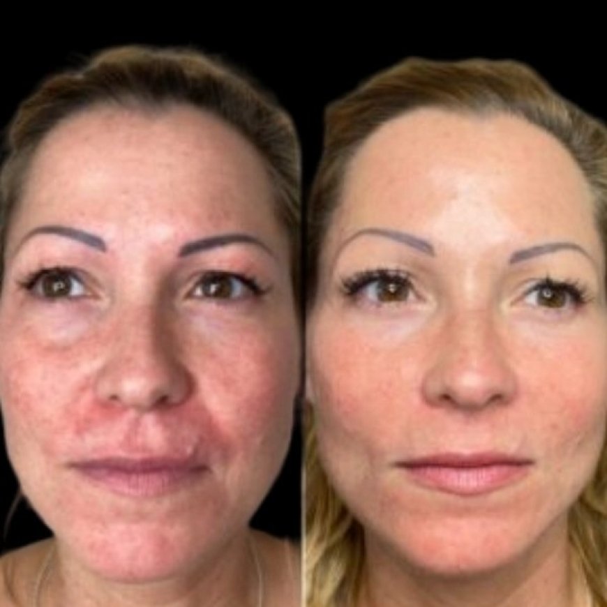 Reignite Radiance with Profhilo by Best Aesthetic Clinic in dubai