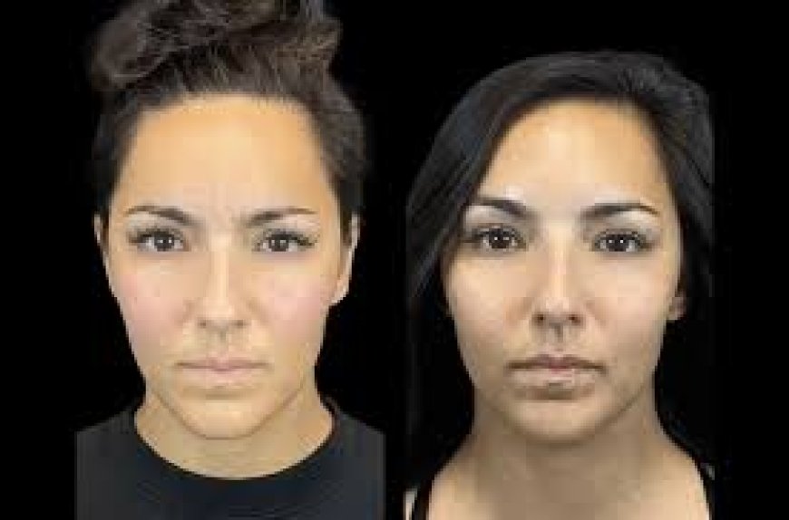 Botox vs. Fillers: Which Is Right for You Visit the Best Aesthetic Clinic in Dubai for Expert Advice