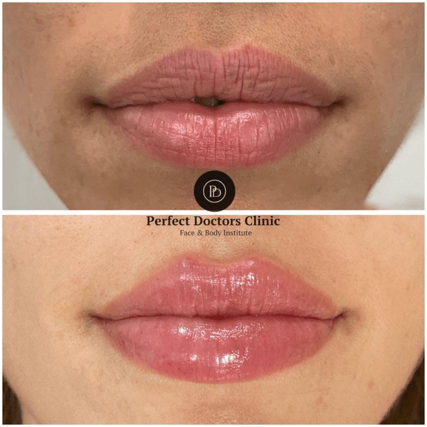Juvederm for Cheek Augmentation: Advice from the Best Doctors in Dubai