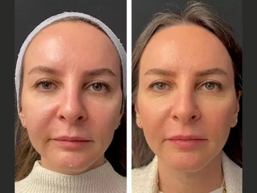 How Long Do Results from Mesotherapy Treatments in Dubai Last?