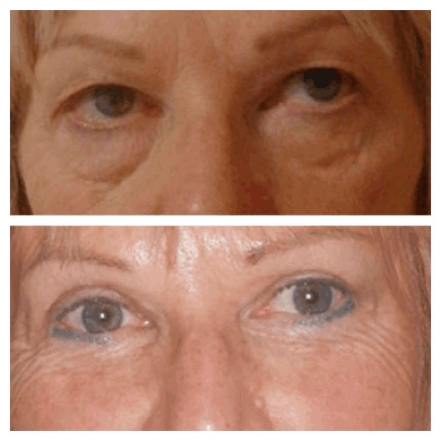 Why You Should Trust the Best Eye Bag Removal Surgeon in Dubai with Your Face