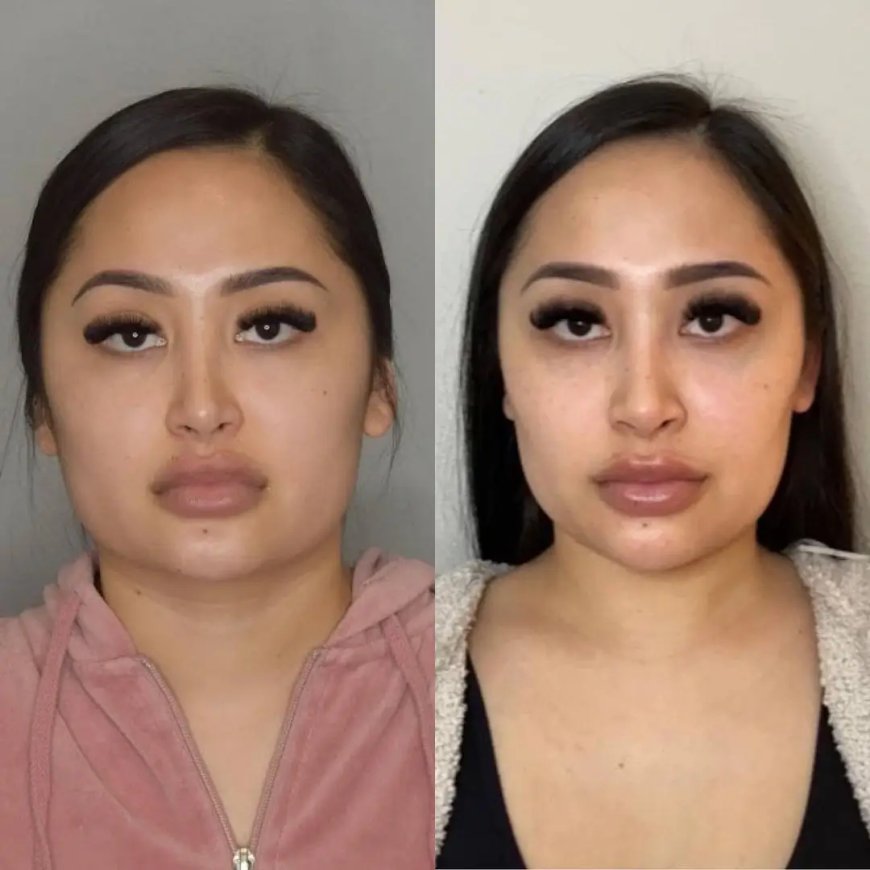 Buccal Fat Removal Cost Breakdown by the Best Buccal Fat Removal Surgeon in Dubai