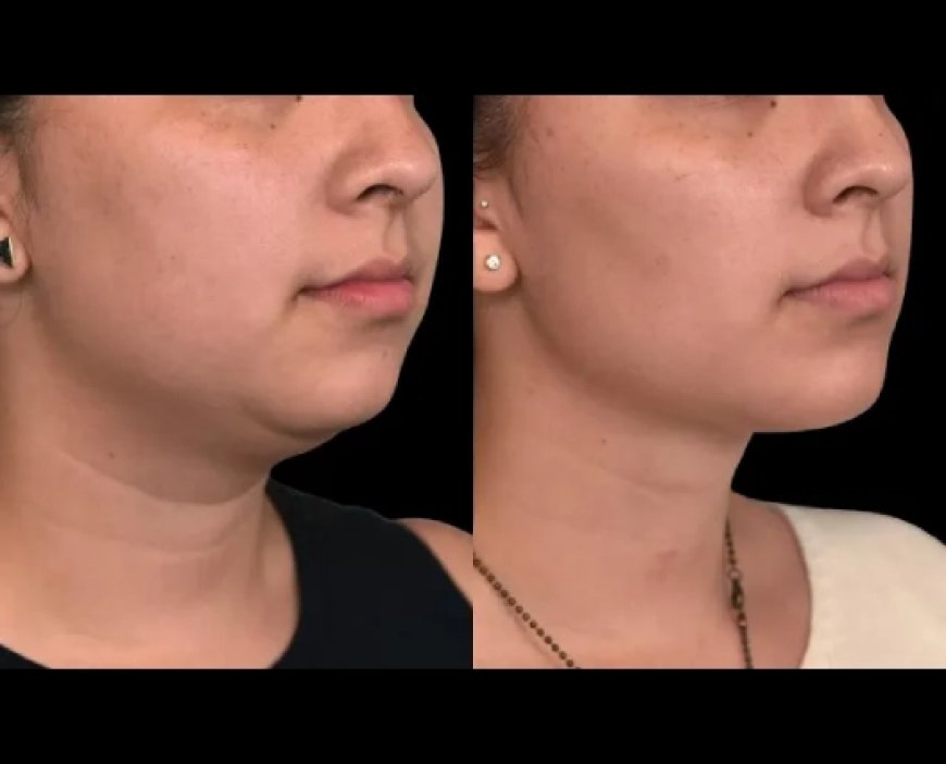 Understanding the Healing Process After Double Chin Removal Surgery with the Best Double Chin Removal Surgeon in Dubai