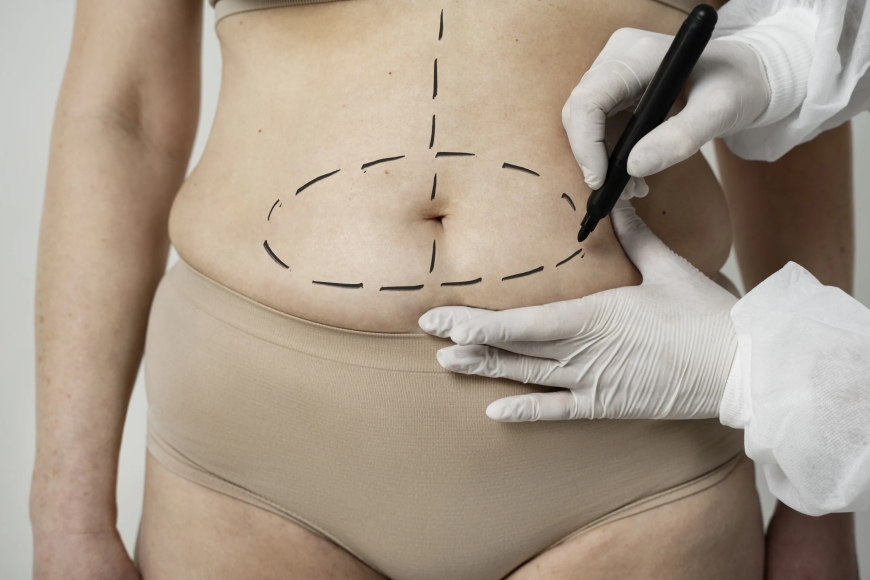 How to Choose the Best Tummy Tuck Surgeon in Dubai for Your Needs