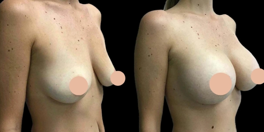 Where to Go for Breast Augmentation in Dubai?