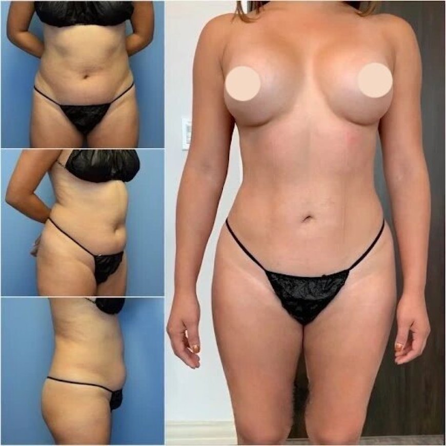 How Body Contouring in Dubai Can Help You Lose Stubborn Fat