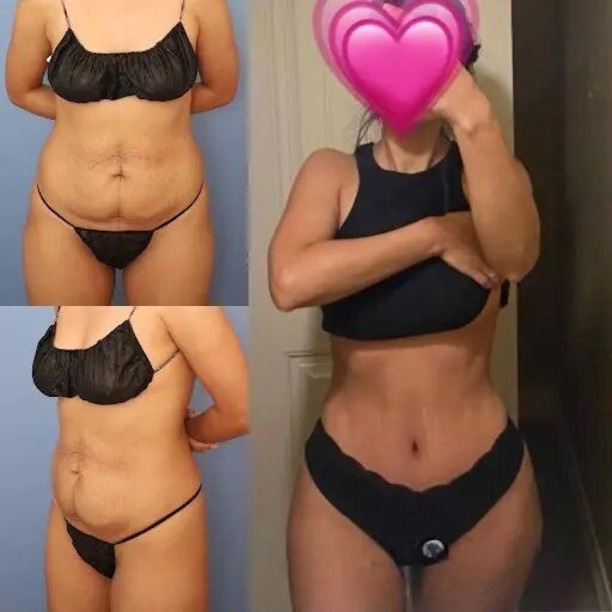Tummy Tuck in Dubai: A Comprehensive Guide to the Procedure
