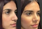 Innovative Techniques by the Best Septoplasty Surgeons in Dubai