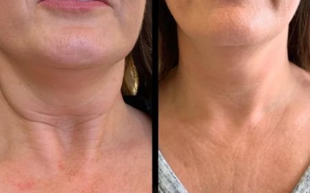 Glow Renewed with Profhilo by the Best Plastic Surgeons in dubai