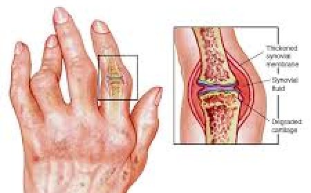 How Aspadol Supports Joint Pain Relief in Chronic Arthritis Patients