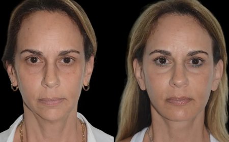 Achieve a Defined Look with Chin Fillers Treatments in Dubai