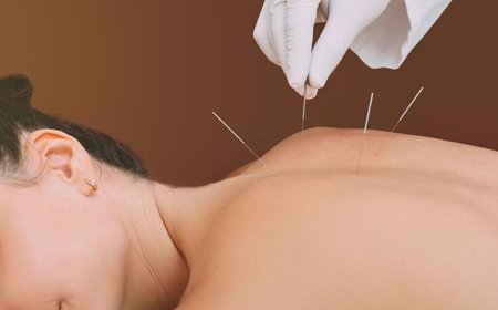 How Acupuncture for Menopause Relief Offers Natural Balance and Comfort