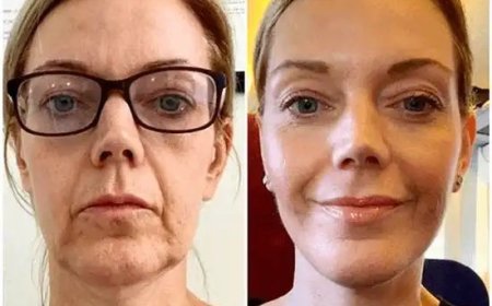 Ignite Your Transformation with Profhilo at the Best Aesthetic Clinics in dubai