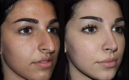 Best Septoplasty Surgeon in Dubai for Minimally Invasive Techniques