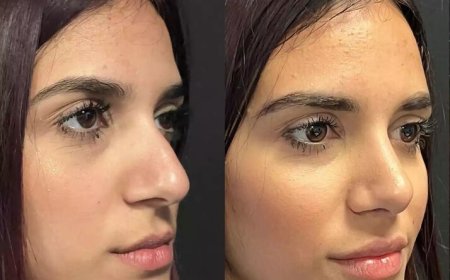 Innovative Techniques by the Best Septoplasty Surgeons in Dubai