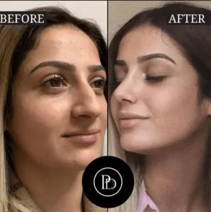 PRP Treatment in Dubai for Hair Loss: What You Need to Know