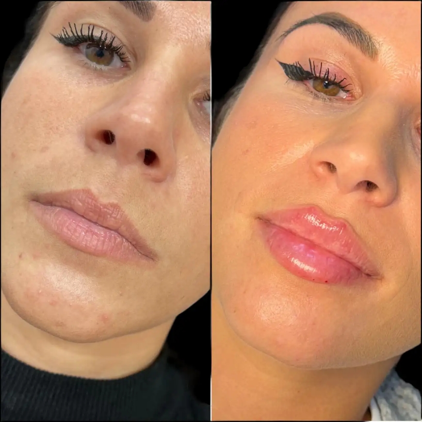 Fillers in Dubai: Everything You Need to Know Before Your First Treatment