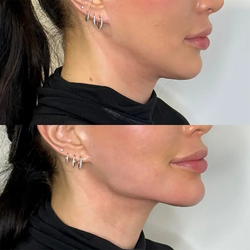 Sculpt and Define with the Best Doctors for Jawline Fillers Treatments in Dubai