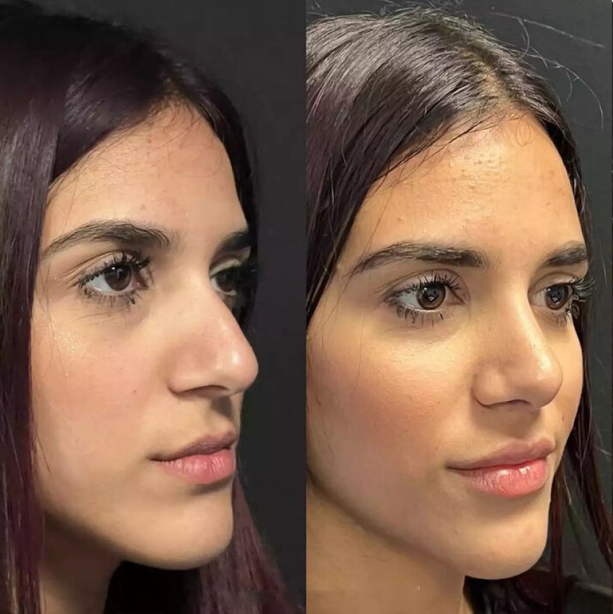 Innovative Techniques by the Best Septoplasty Surgeons in Dubai